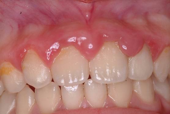 牙垢堆積形成牙齦紅腫
